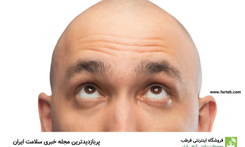 علت طاسی سر چیست؟ آیا راهی برای پیشگیری و درمان طاسی وجود دارد؟