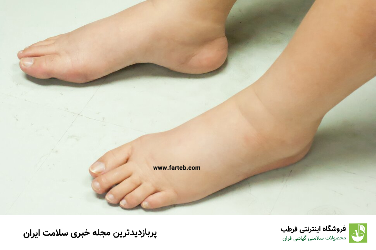 چرا مچ پایتان ورم کرده است؟