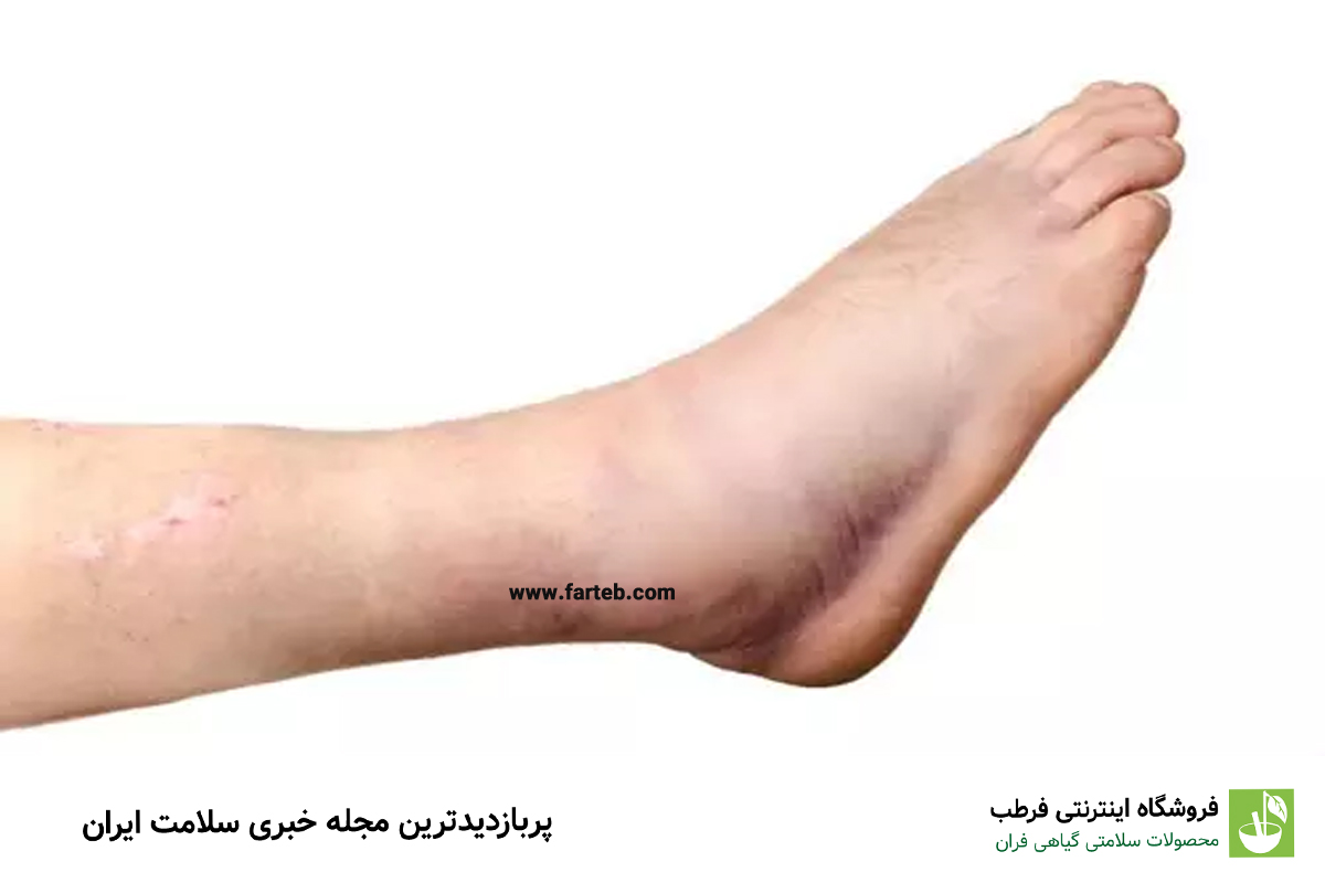 چرا مچ پایتان ورم کرده است؟