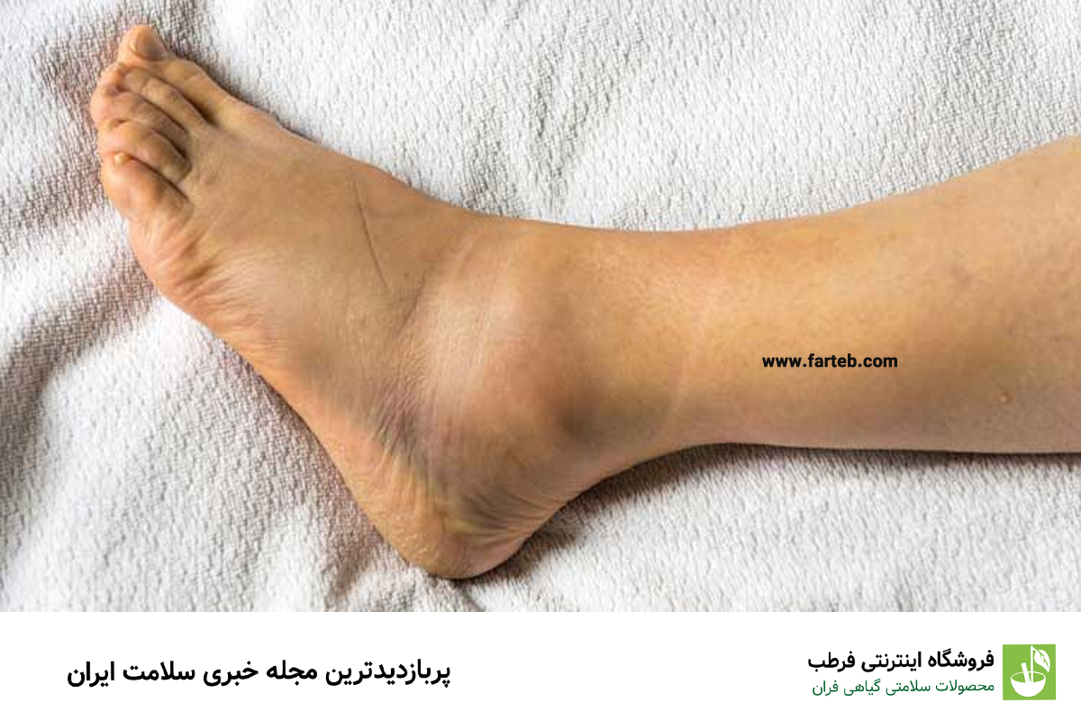 چرا مچ پایتان ورم کرده است؟