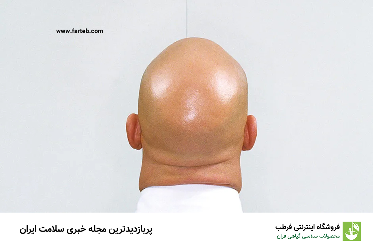 علت طاسی سر چیست؟ آیا راهی برای پیشگیری و درمان طاسی وجود دارد؟