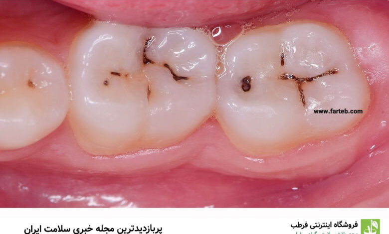 برای جلوگیری از پوسیدگی دندان لب به این غذاها نزنید