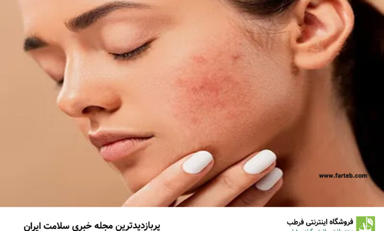 ۳ ماده غذایی مضر برای سلامت پوست