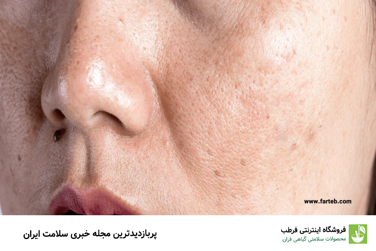 علت تیرگی پوست صورت چیست؟