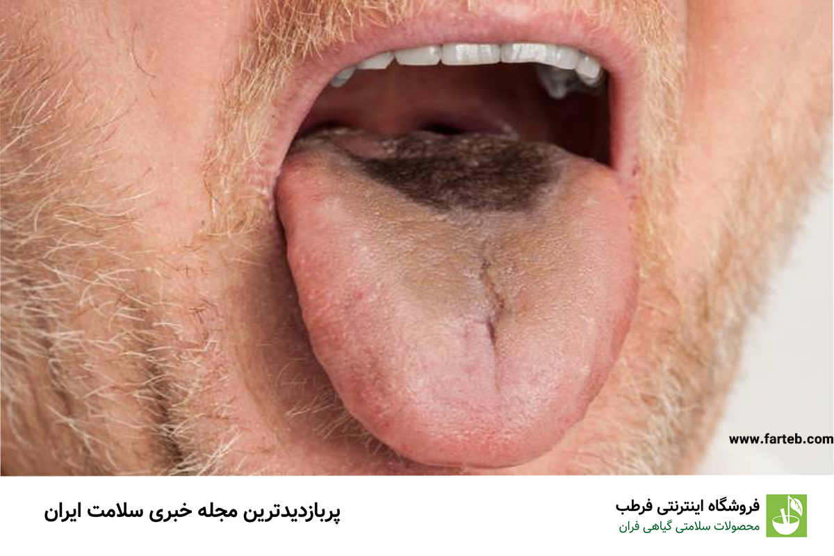زبان مودار: علل و روشهای پیشگیری