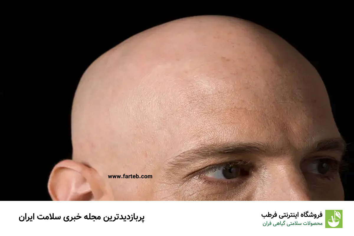 علت طاسی سر چیست؟ آیا راهی برای پیشگیری و درمان طاسی وجود دارد؟
