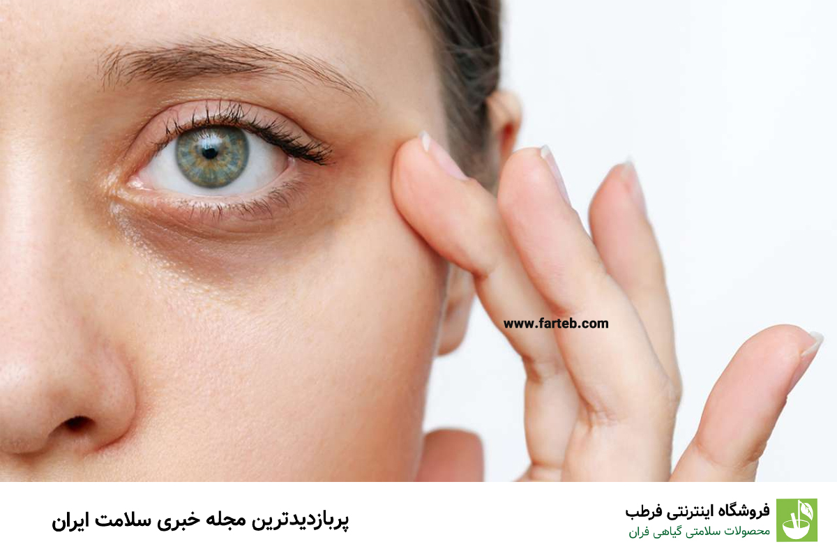 سیاهی دور چشم کمبود چه ویتامینی است؟