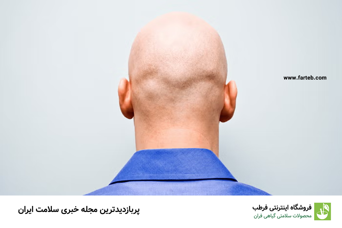 علت طاسی سر چیست؟ آیا راهی برای پیشگیری و درمان طاسی وجود دارد؟
