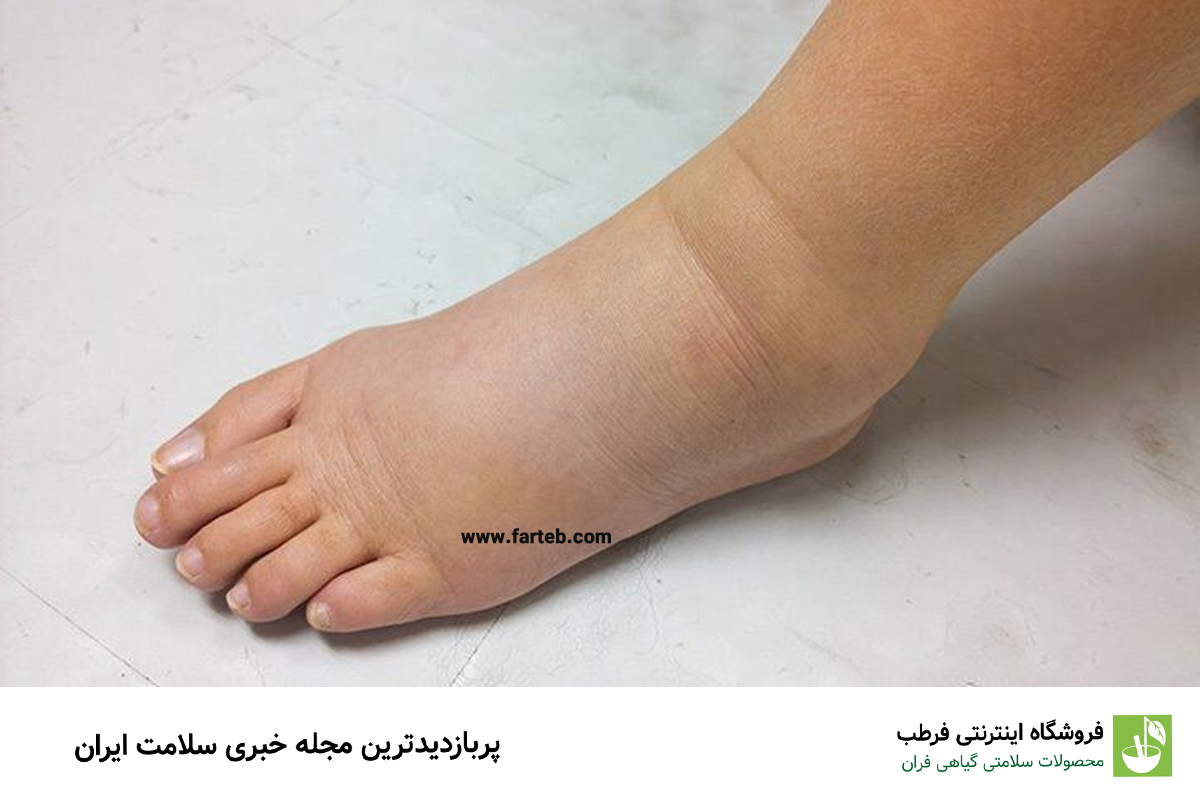 چرا مچ پایتان ورم کرده است؟