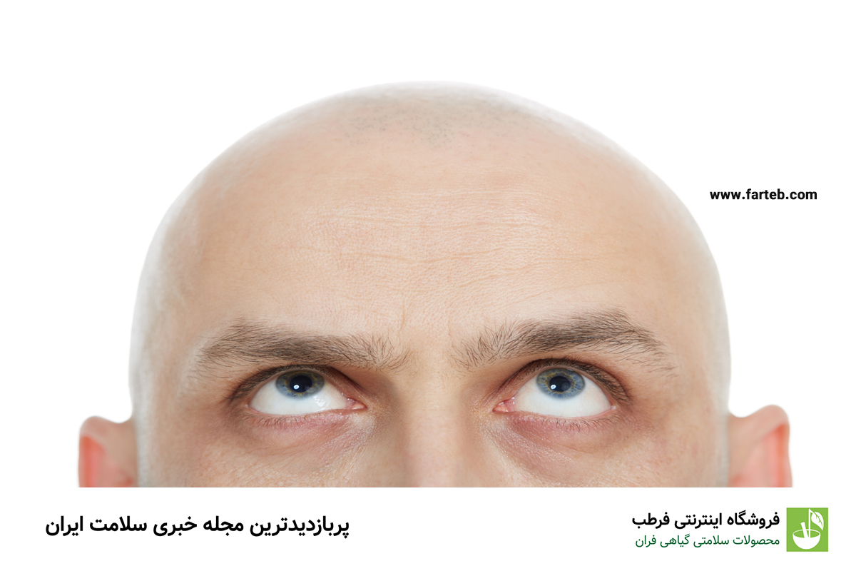 علت طاسی سر چیست؟ آیا راهی برای پیشگیری و درمان طاسی وجود دارد؟
