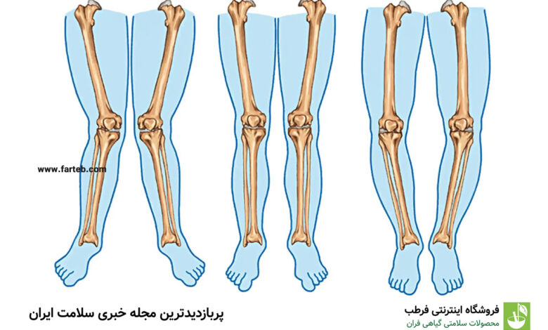 درمان پای پرانتزی
