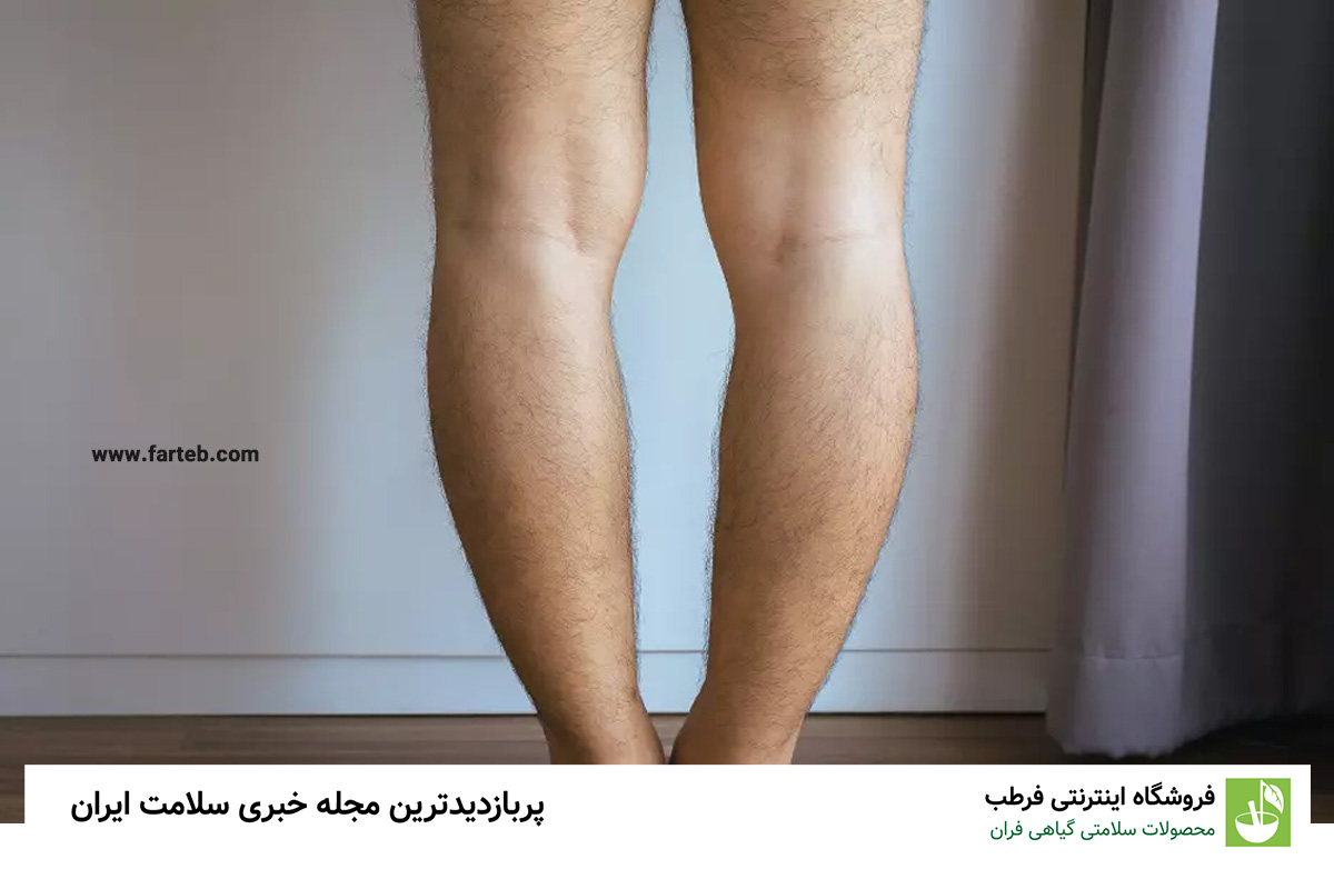 درمان پای پرانتزی
