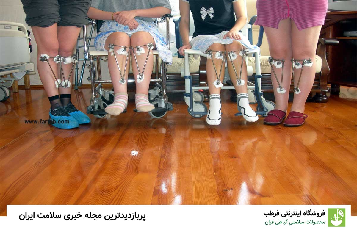 درمان پای پرانتزی