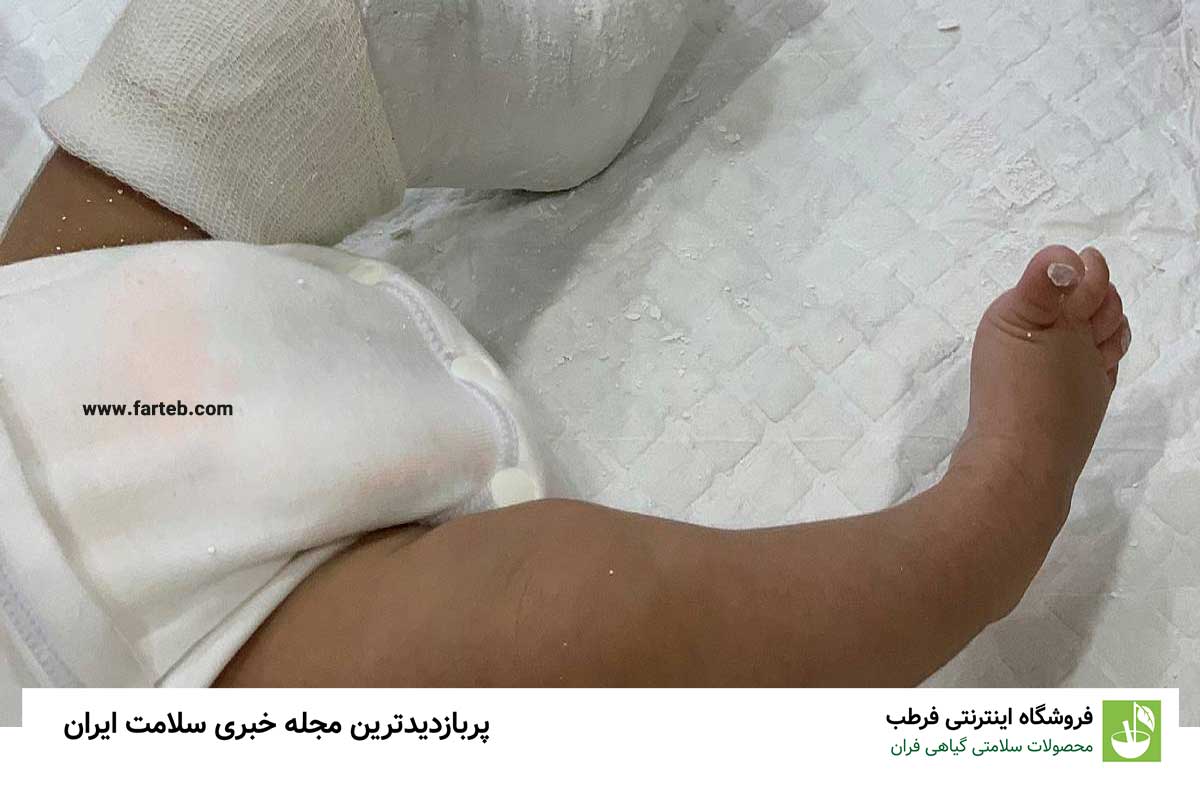 درمان پای پرانتزی