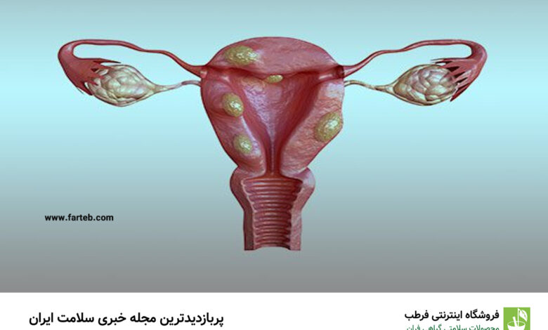 کدام ویتامین باعث کاهش خطر فیبروم رحم می شود؟