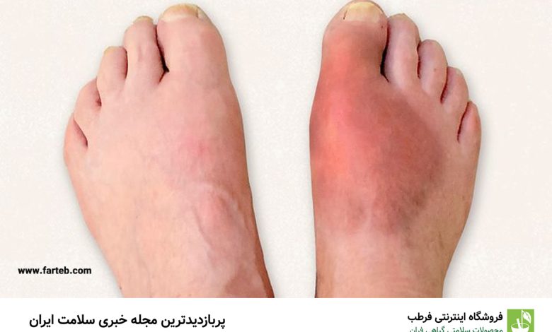 بیماری هایی که می توان از طریق تغییرات پا تشخیص داد!