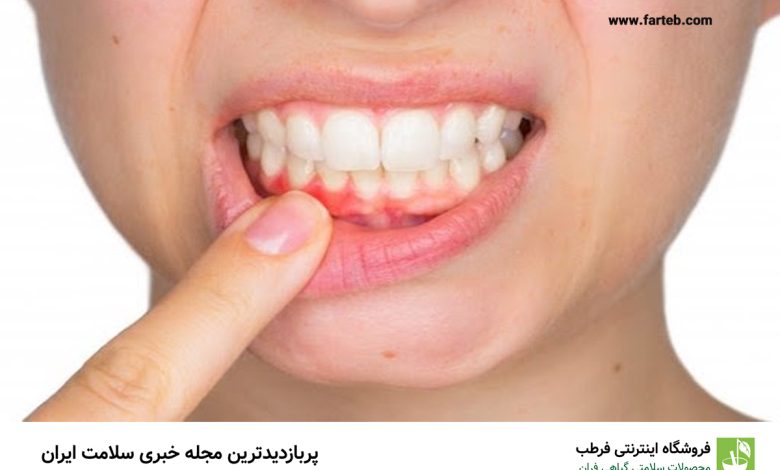 برای تقویت لثه چه بخوریم؟ تغذیه مفید برای لثه و دهان
