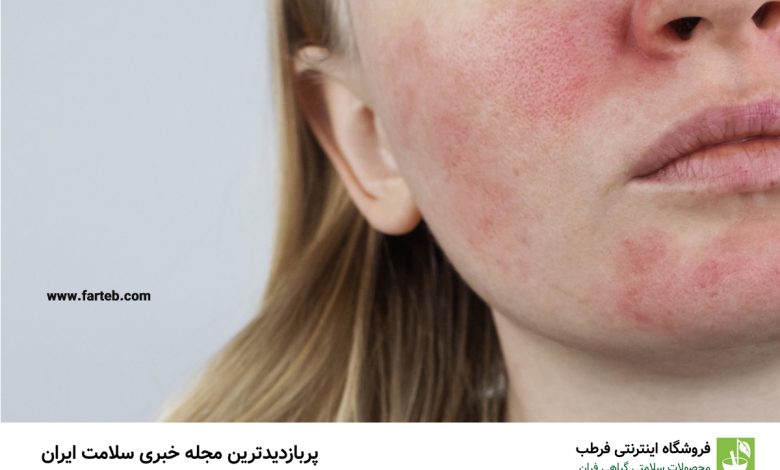 بیماری روزاسه چیست؟ بررسی کامل علائم و روش های درمان آن