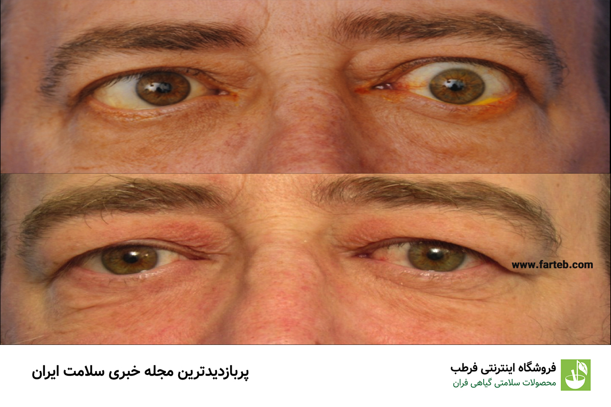 لوچ شدن چشمها: علامتی از تغییرات در ساختار چشم
