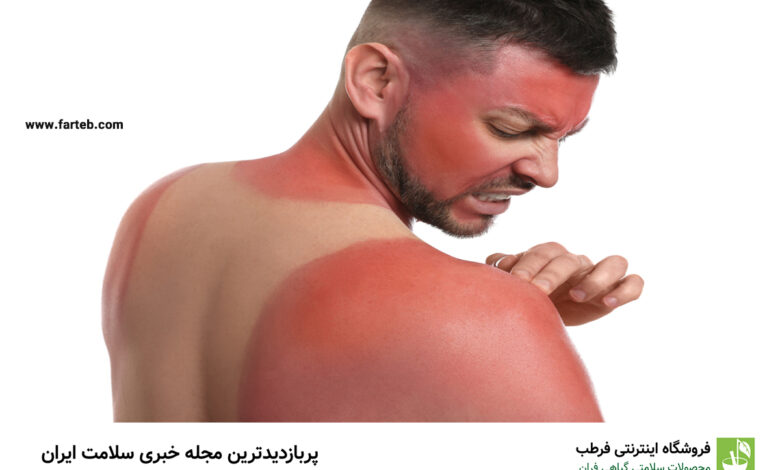 آفتاب سوختگی را با مالیدن این مواد غذایی روی پوست درمان کنید!