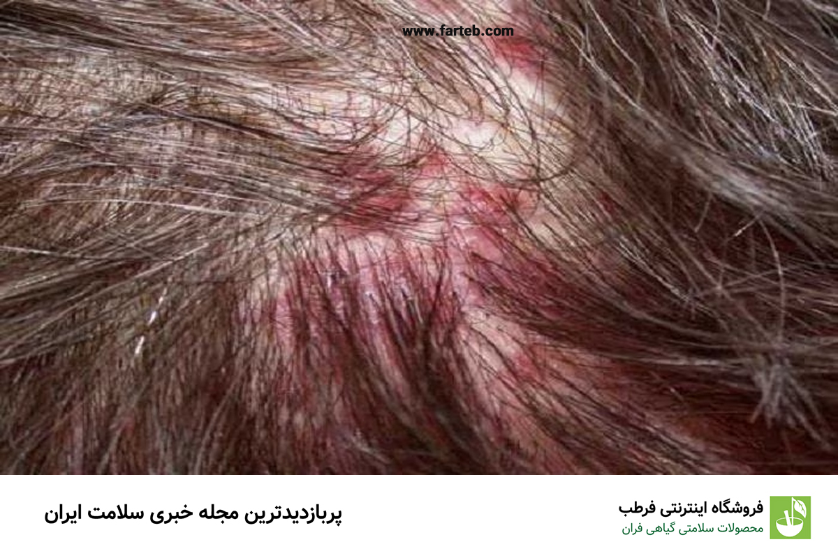 آکنه و خارش سر: چگونه از جوش‌های پوست سر جلوگیری کنیم؟