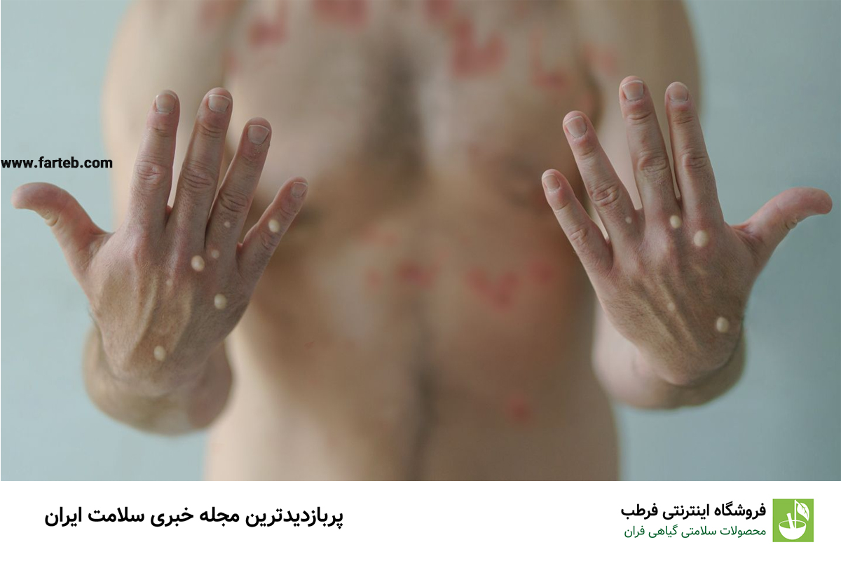 آبله میمونی، تهدید جدید برای سلامت جهانی
