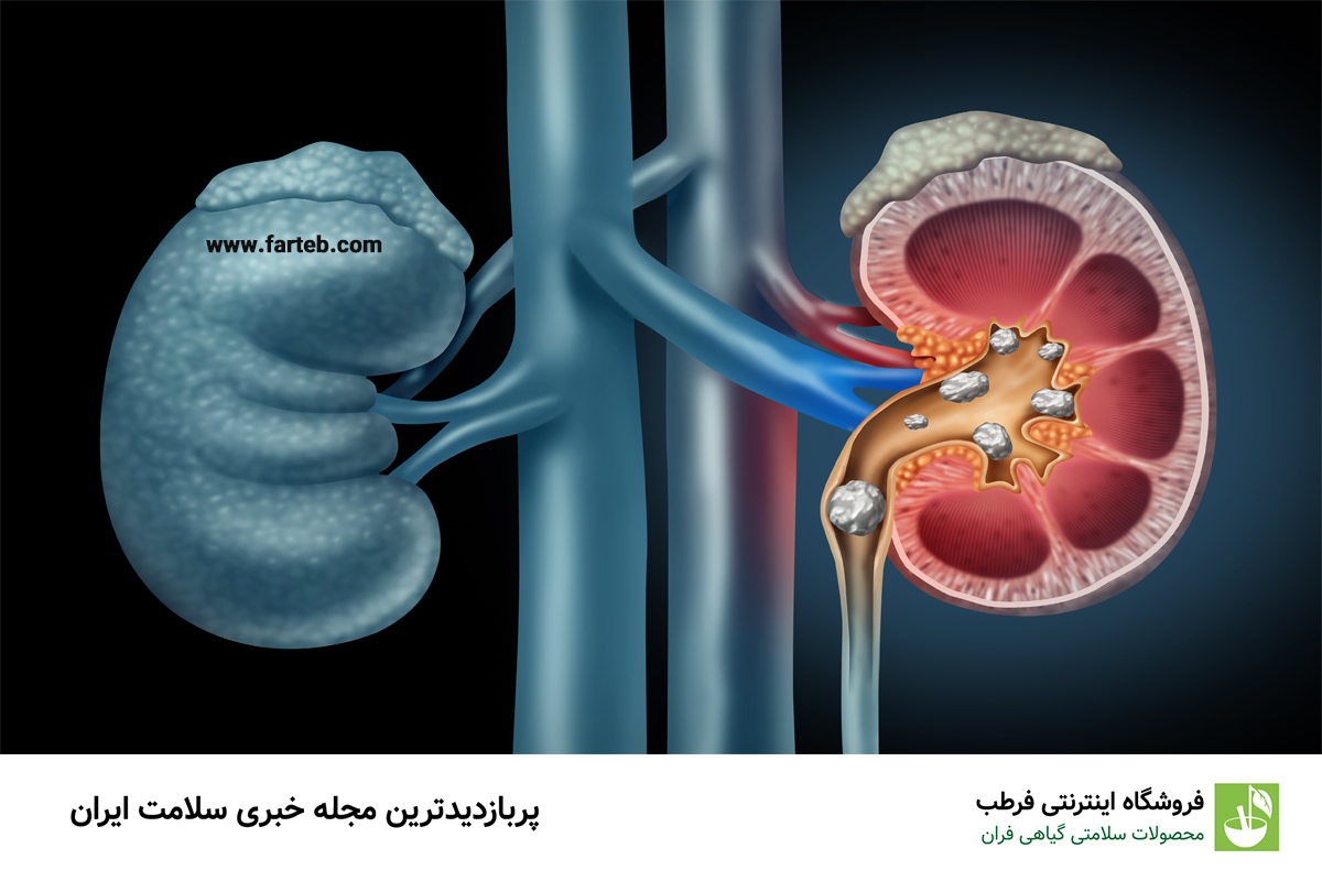 دم‌کرده این سبزی ناشتا سنگ کلیه رو پودر می‌کنه | نابودگر سنگ کلیه کشف شد