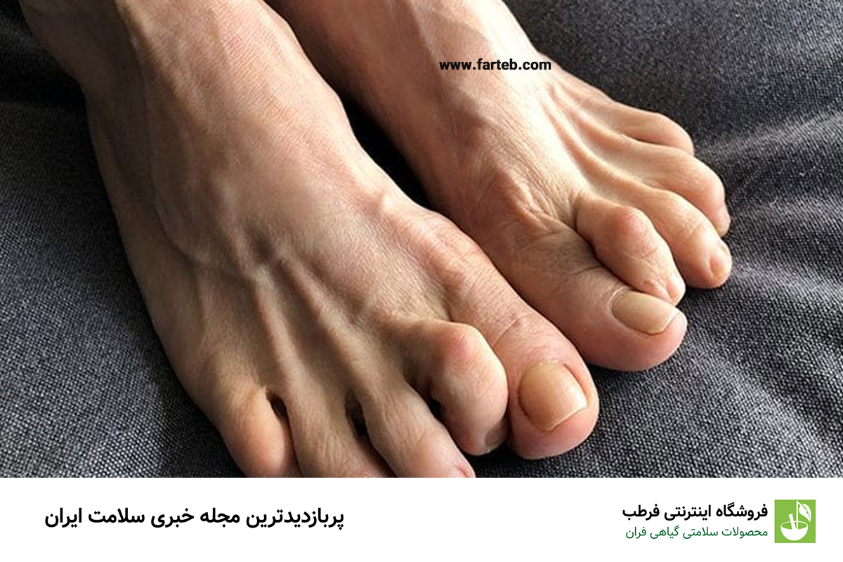 انگشت خمیده پا: علامتی از بیماری‌های ریوی و ناراحتی قلبی