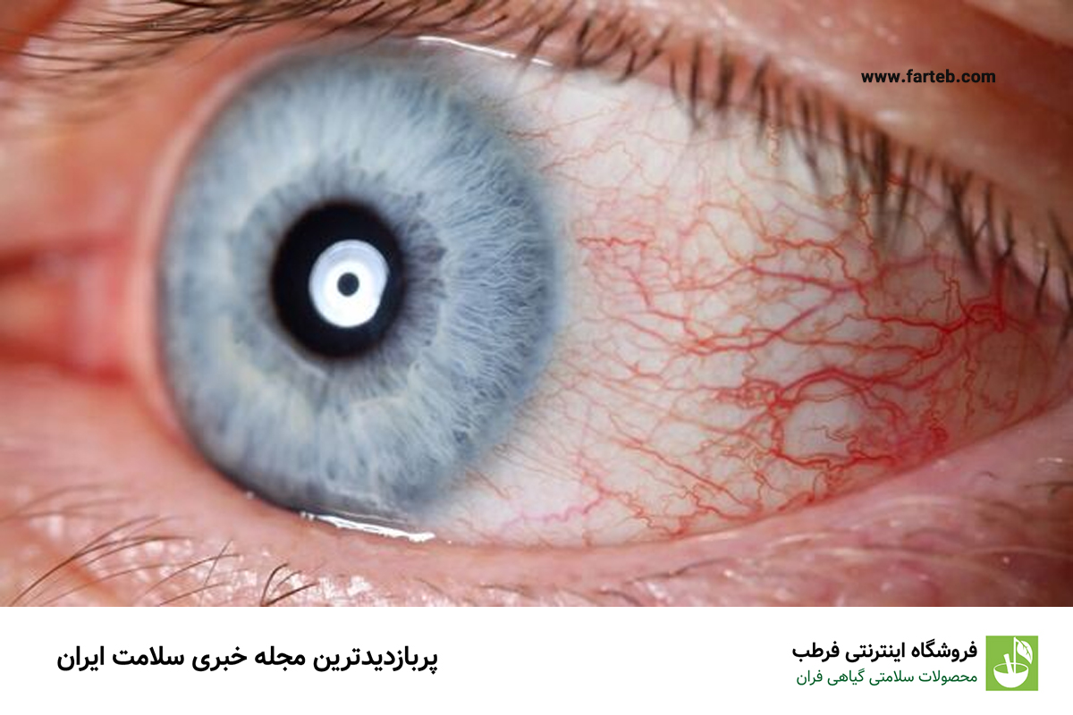 سکته چشمی چیست؟ بررسی علل، علائم و خطر های آن