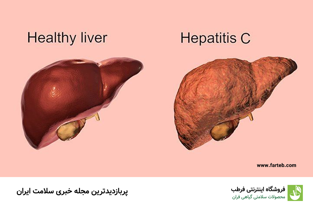 درمان هپاتیت C: راهکارها و روشهای نوین