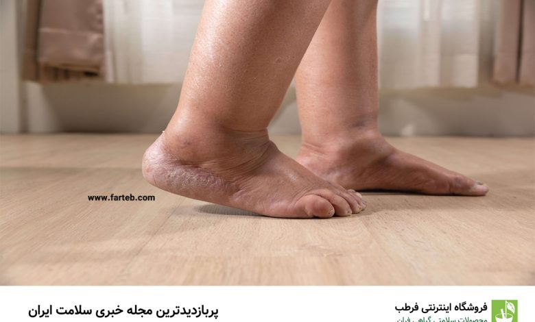 بهترین راه برای کمک به پاهایی که ورم میکنند