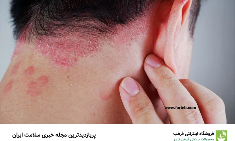چه ویتامینی برای پسوریازیس خوب است؟