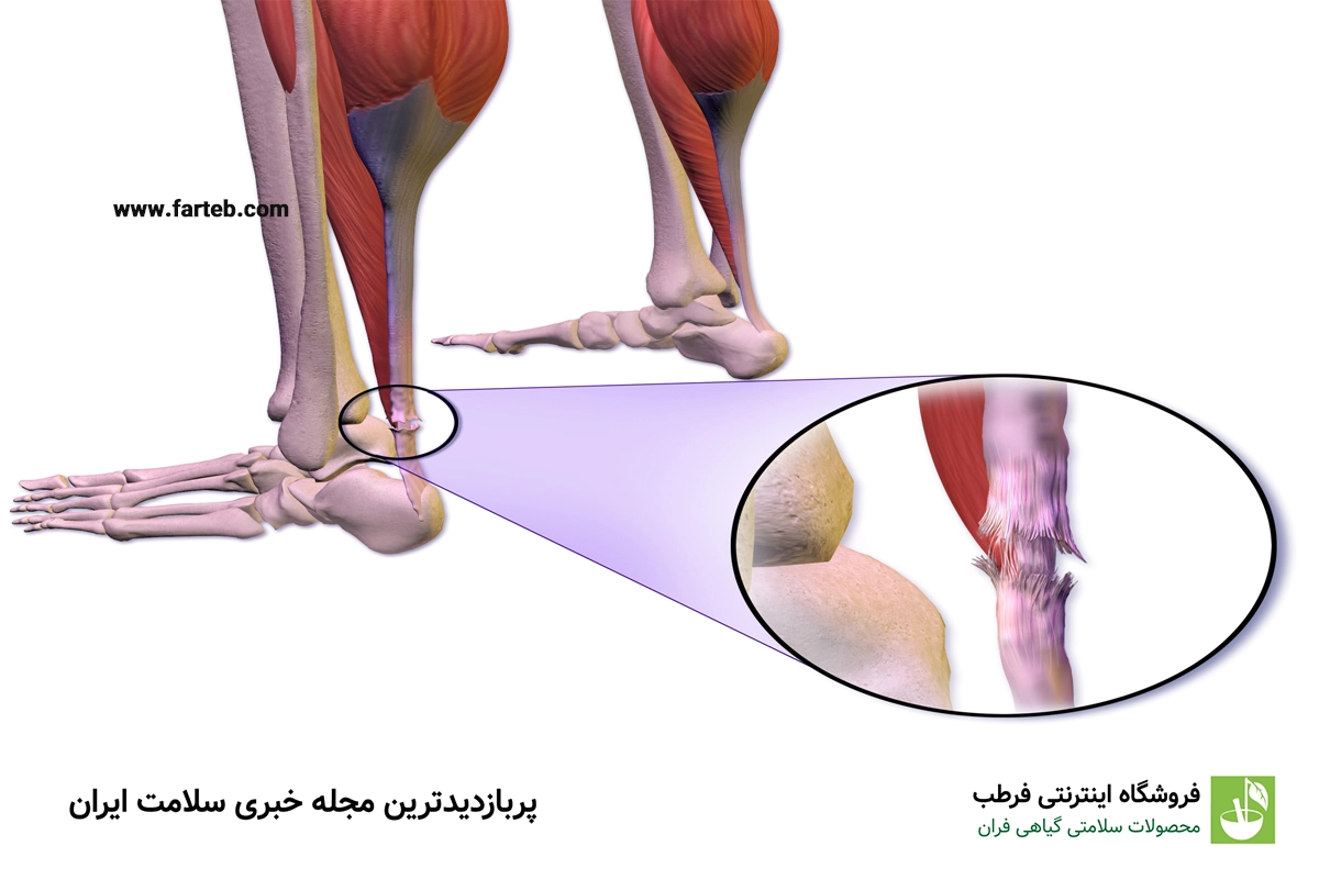 تاندون چیست و چه عملکردی در بدن دارد؟