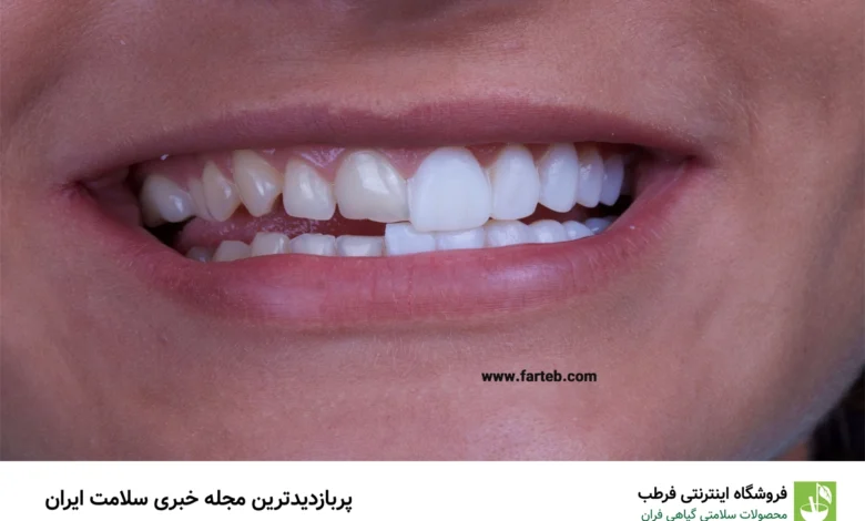 هر آنچه که باید درباره روکش دندان بدانید