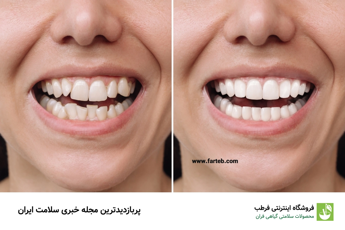 هر آنچه که باید درباره روکش دندان بدانید