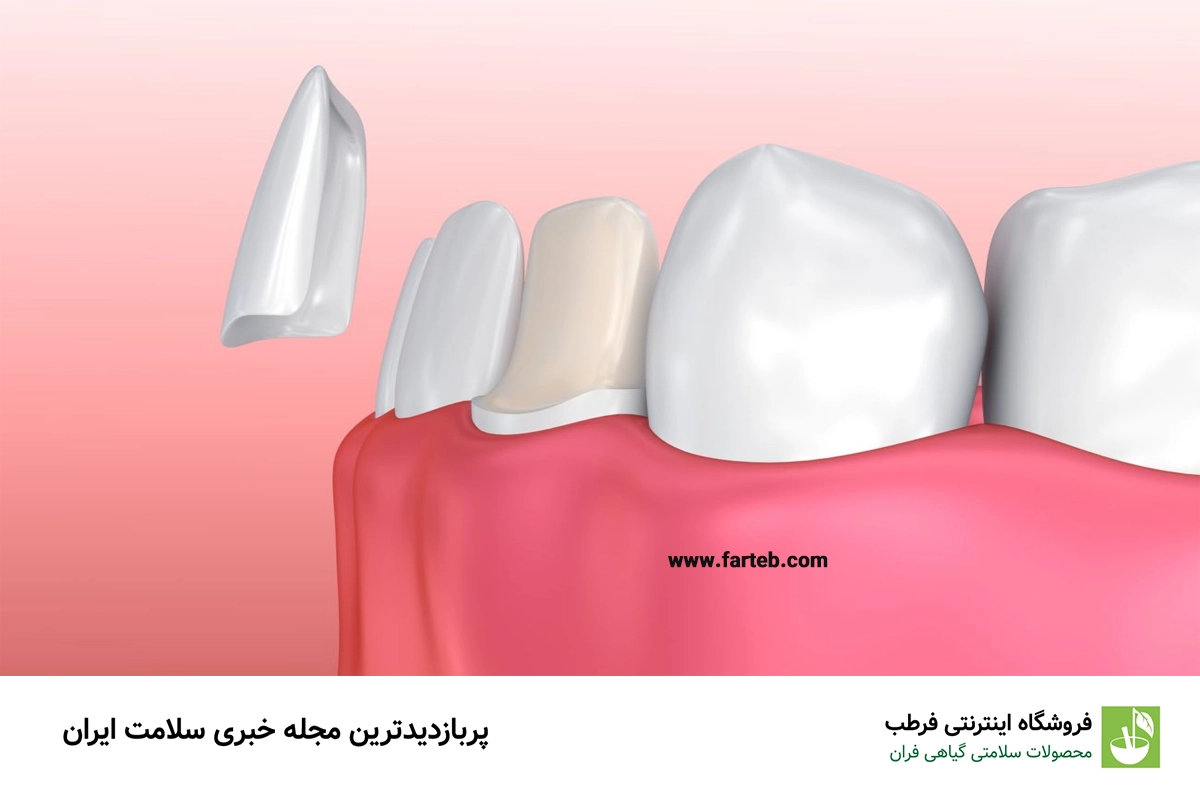 هر آنچه که باید درباره روکش دندان بدانید