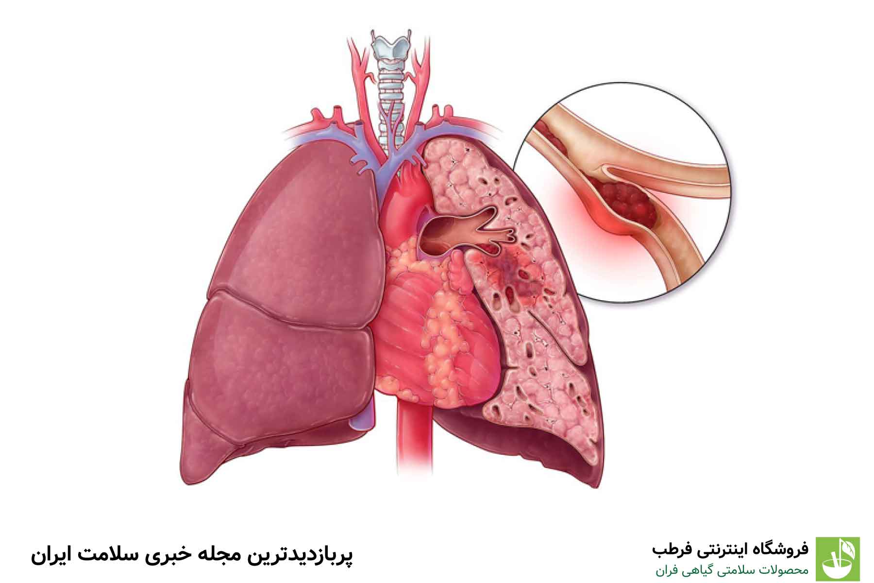 علائم آمبولی ریه