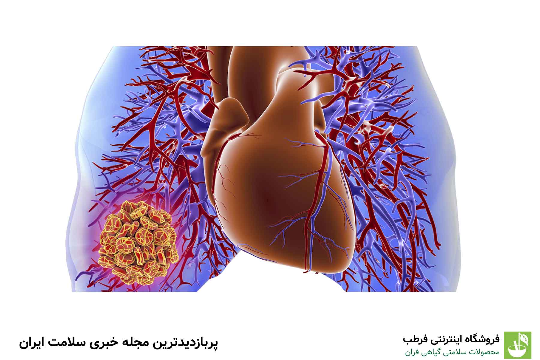 عوامل خطر آمبولی ریه