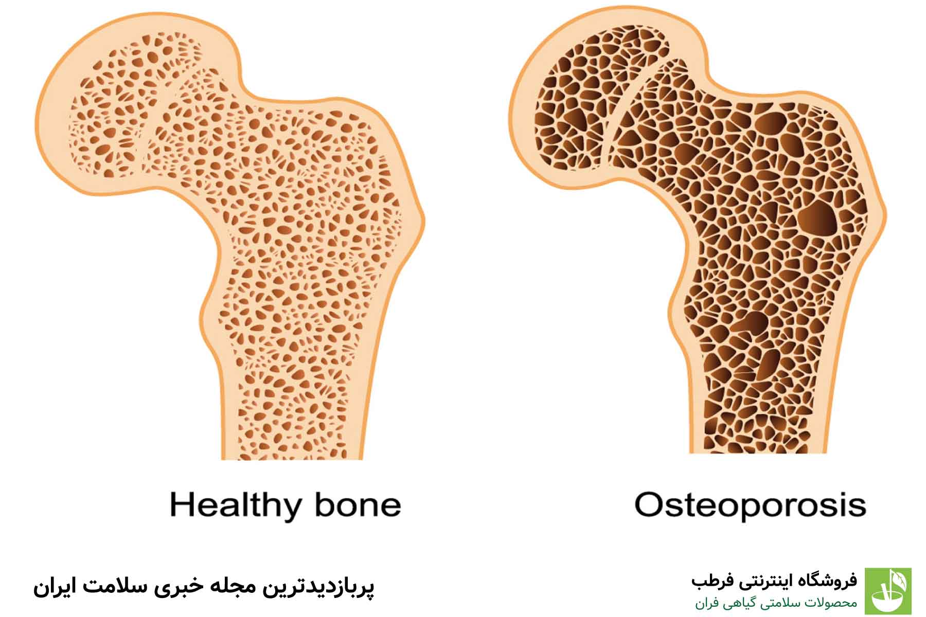 علائم پوکی استخوان چیست؟