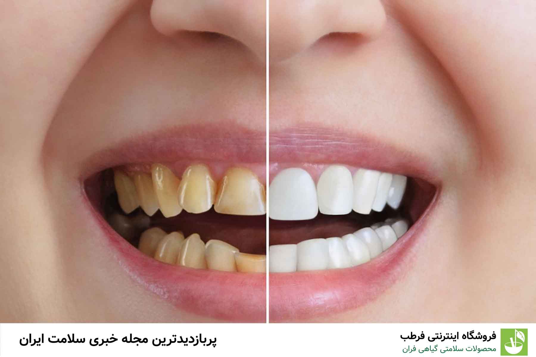 4. استفاده از دهانشویه‌های نامناسب
