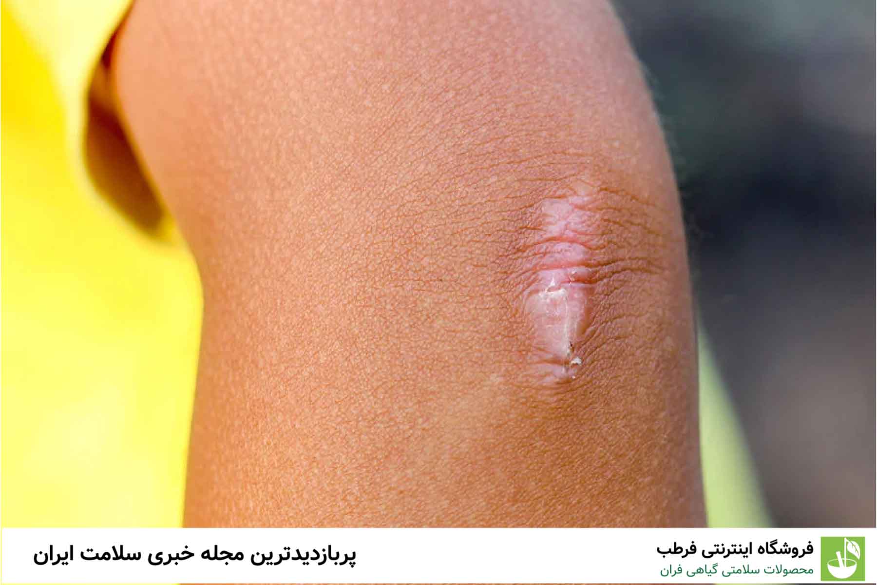 2. سیگار کشیدن