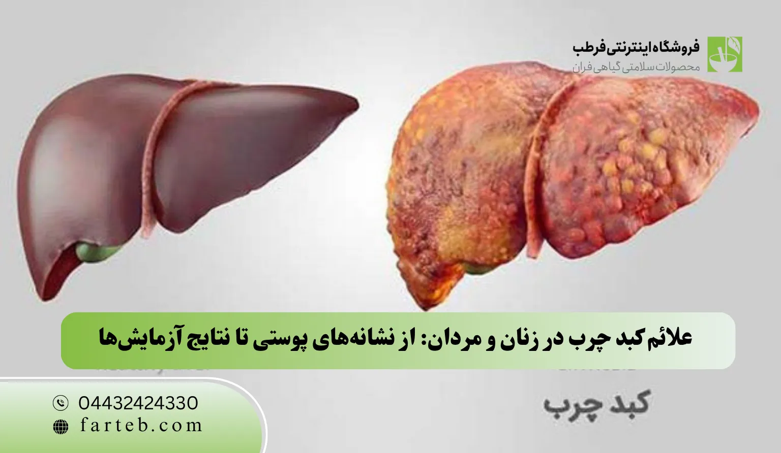 علائم کبد چرب در زنان و مردان: از نشانههای پوستی تا نتایج آزمایشها