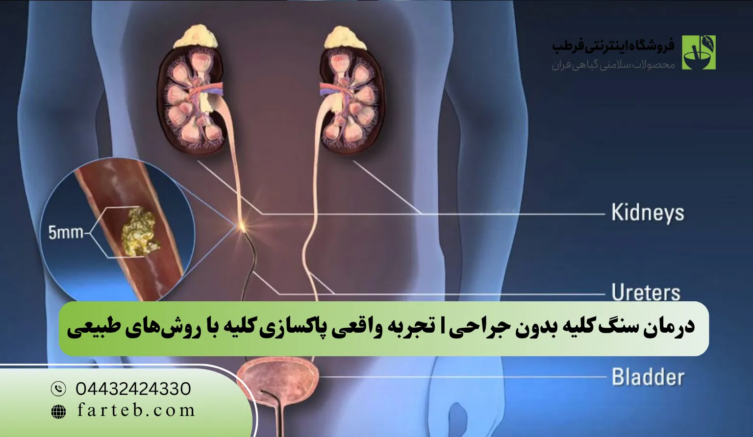 درمان سنگ کلیه بدون جراحی | تجربه واقعی پاکسازی کلیه با روش‌های طبیعی
