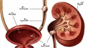 سنگ کلیه را بدون جراحی دفع کنید؛ روش‌های خانگی ثابت‌شده در طب سنتی