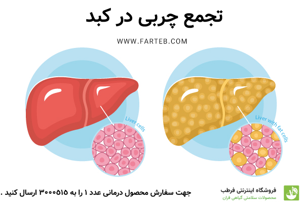 درمان کبد چرب؛ سریع ترین روش های علمی، تغذیه و طب سنتی کبد چرب چیست